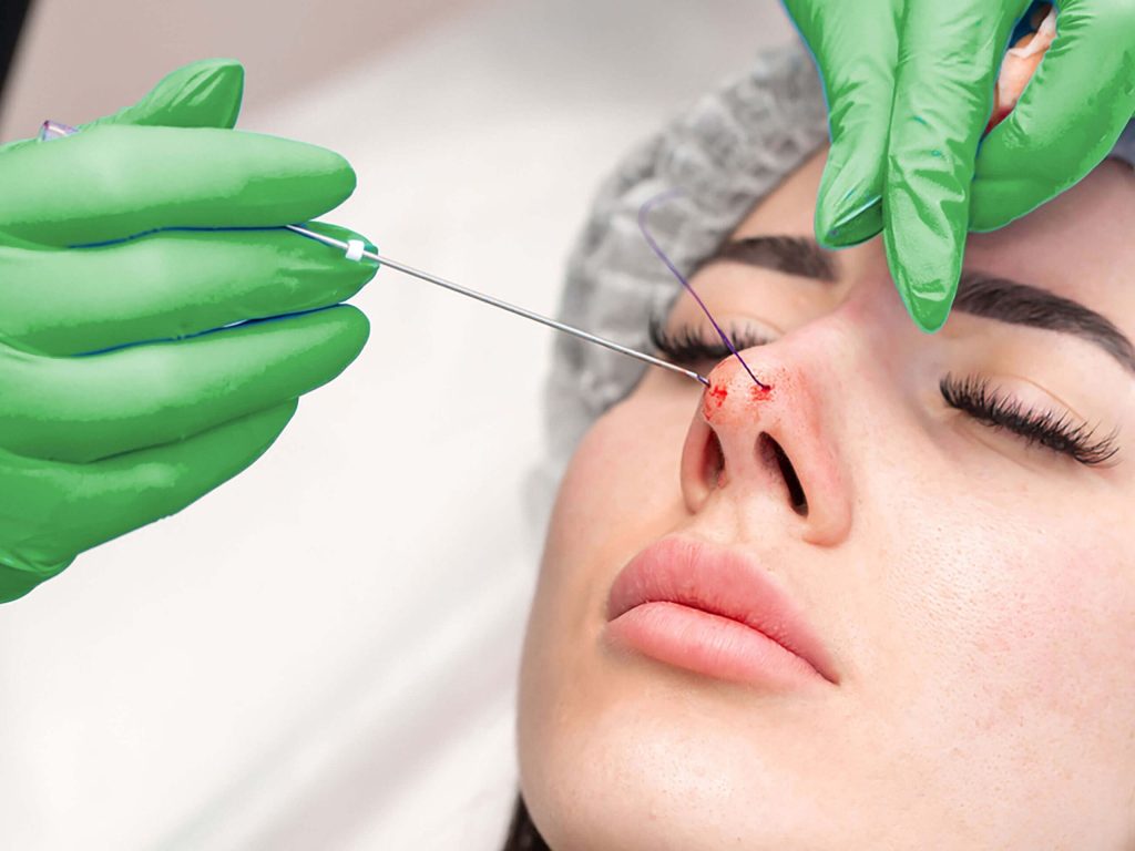 لیفت بینی با نخ چگونه است؟