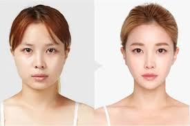 جراحی وی‌لاین چیست؟ راهنمای کامل، مزایا، عوارض