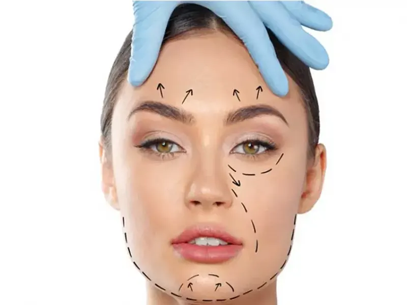 لیفت با نخ چقدر دوام داره؟