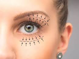 آیا جراحی پلک (بلفاروپلاستی) ریسکی برای بینایی دارد یا بی‌خطر است؟