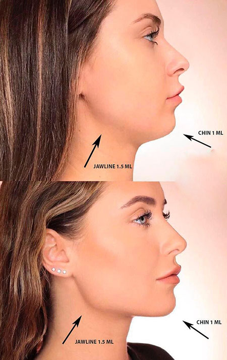 راهنمای کامل زاویه سازی فک و مدلینگ صورت