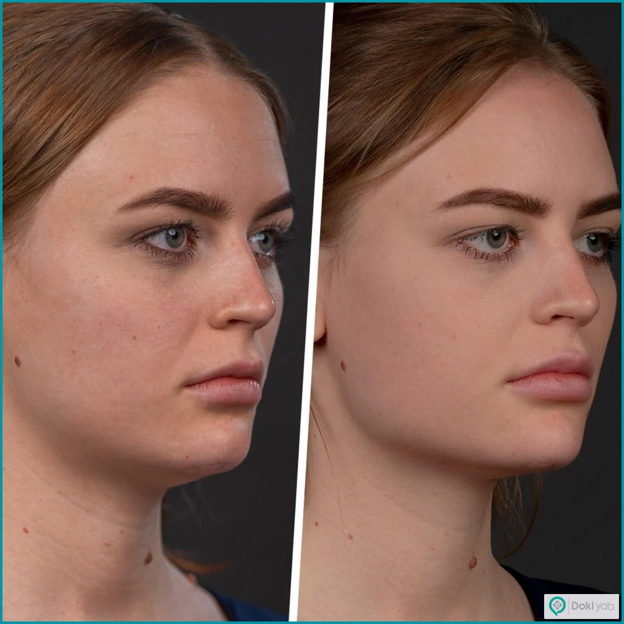 ایمپلنت چانه: راه‌حلی دائمی برای زاویه‌سازی صورت