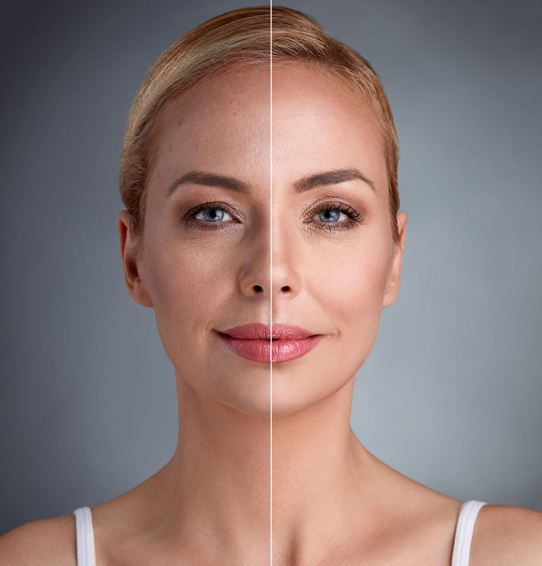 تأثیر رنگ پوست بر تعداد جلسات لیزر موهای زائد